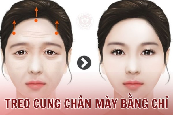 Treo chân mày bằng chỉ: Những ưu - nhược điểm cần lưu ý
